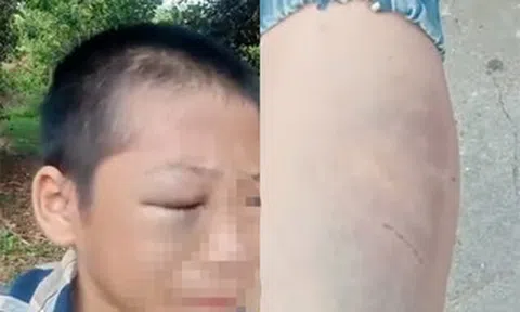 Xôn xao clip bé trai mắt bầm tím, khóc kêu cứu vì nhiều lần bị đánh đập khi ở cùng bố và vợ mới