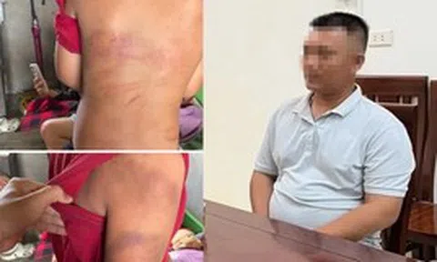 Vụ bé trai 10 tuổi người thâm tím nghi bị bạo hành: Lời khai của bố đẻ